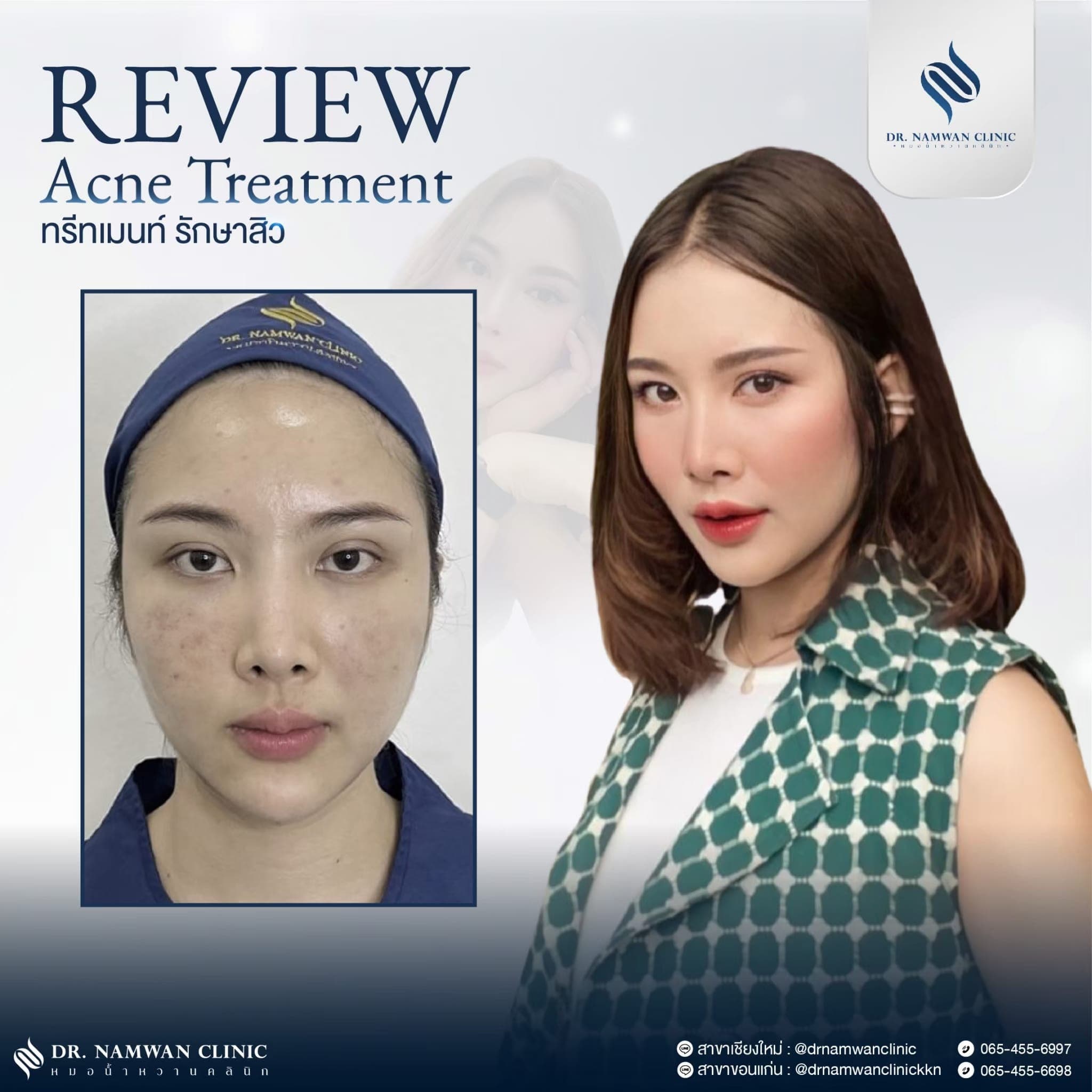Before and after: Acne treatment / clear skin