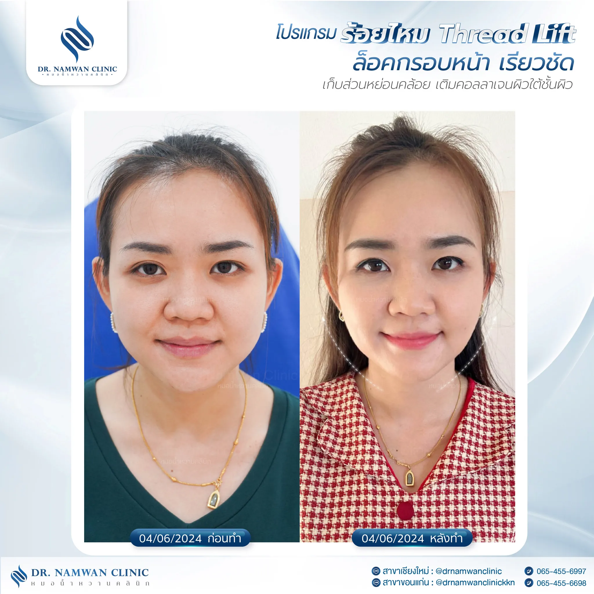 Before and after: Before and after results