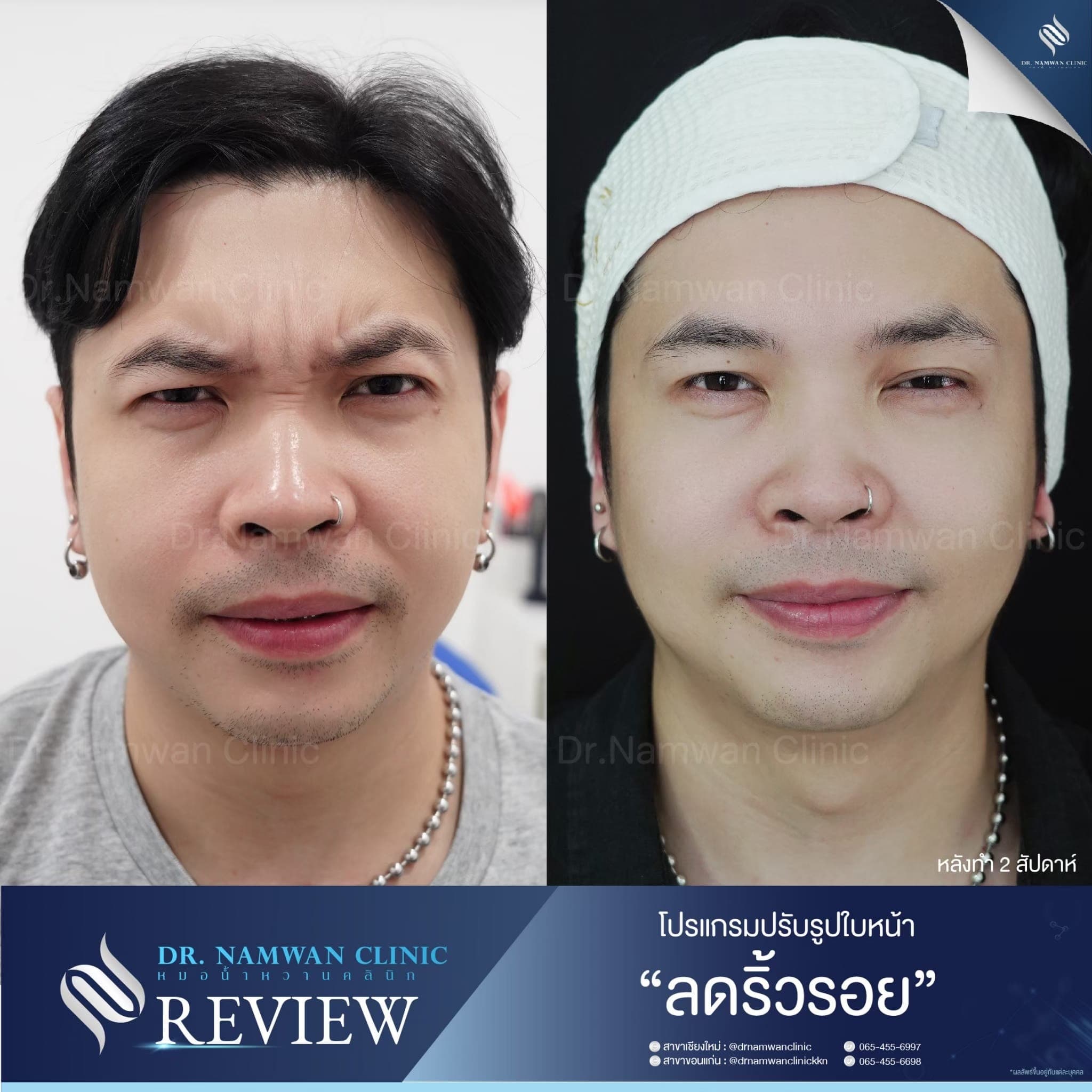 Before and after: Wrinkle reduction / botulinum