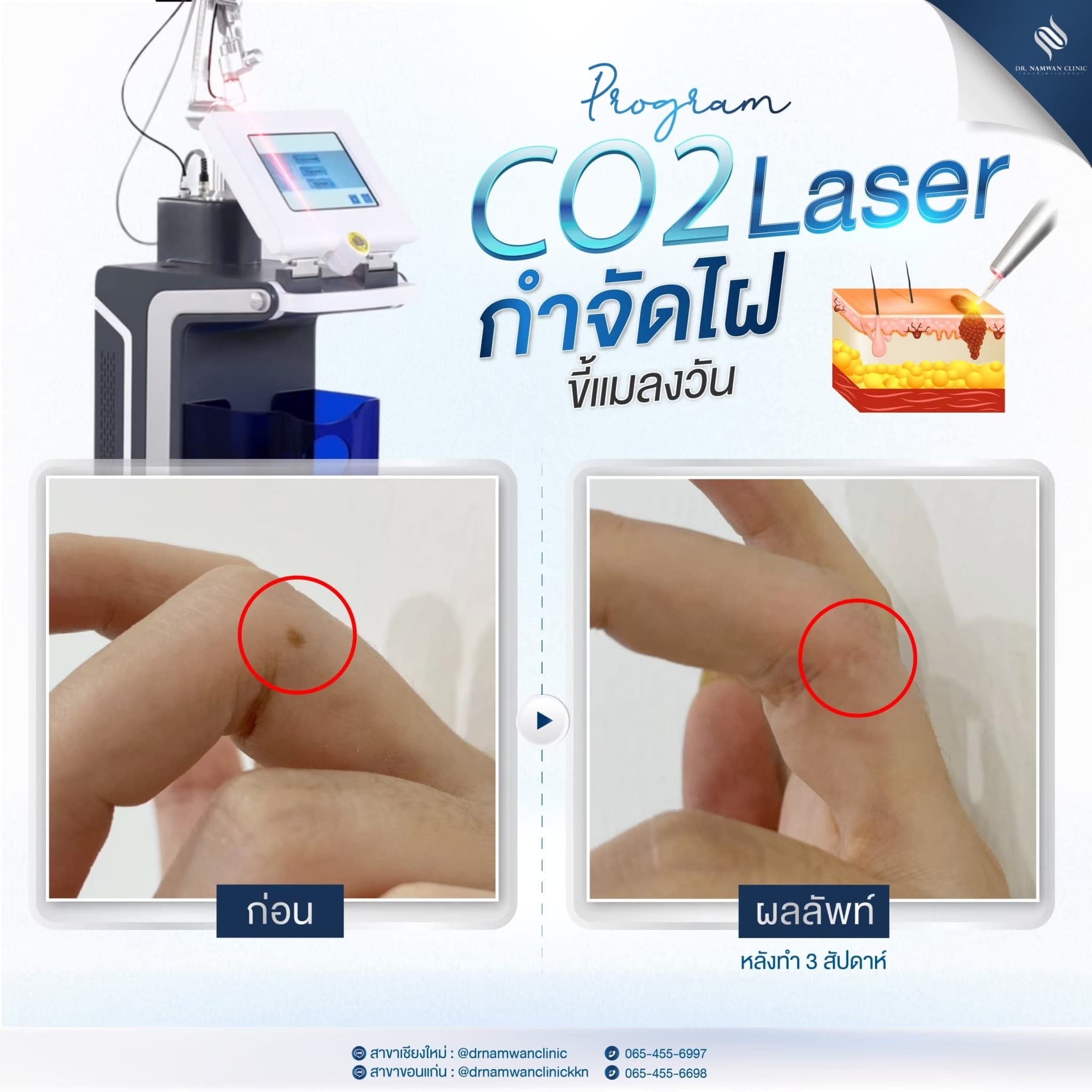 Before and after: CO2 Laser