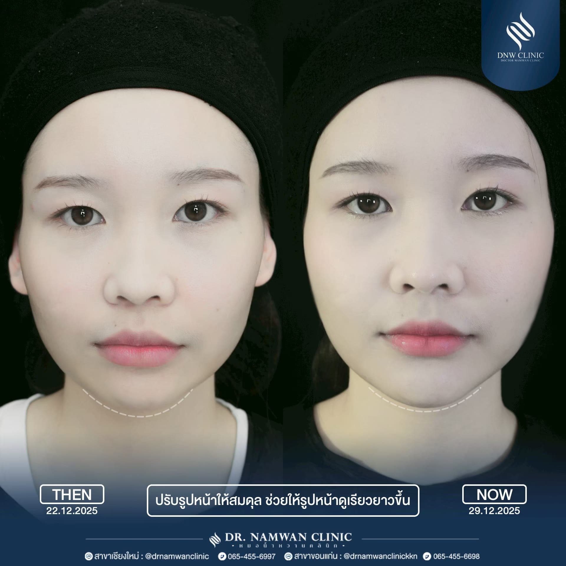 Before and after: Filler injection