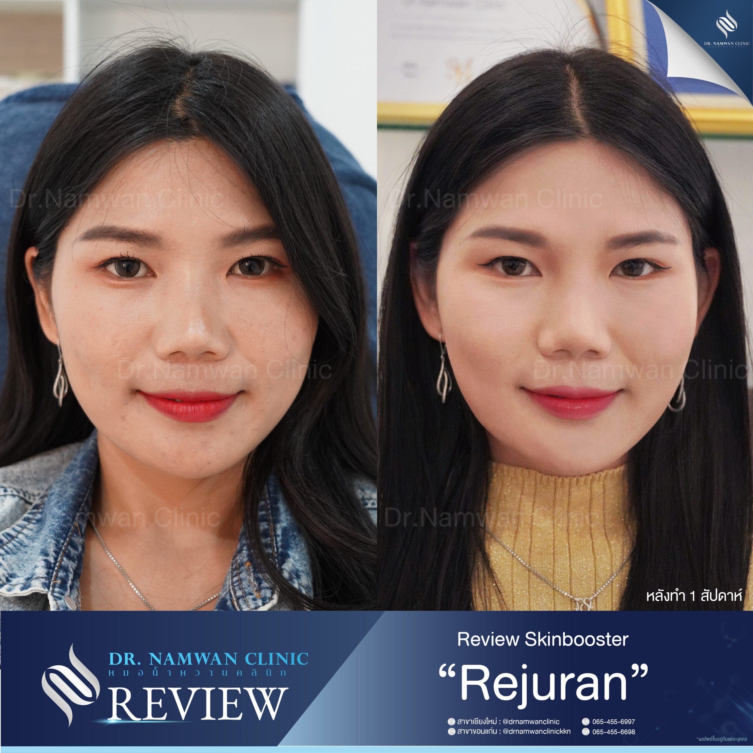 Before and after: Rejuran