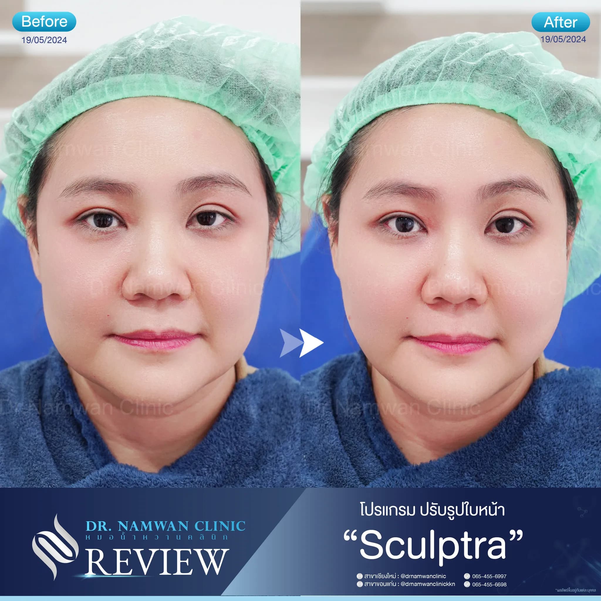 Before and after: Sculptra