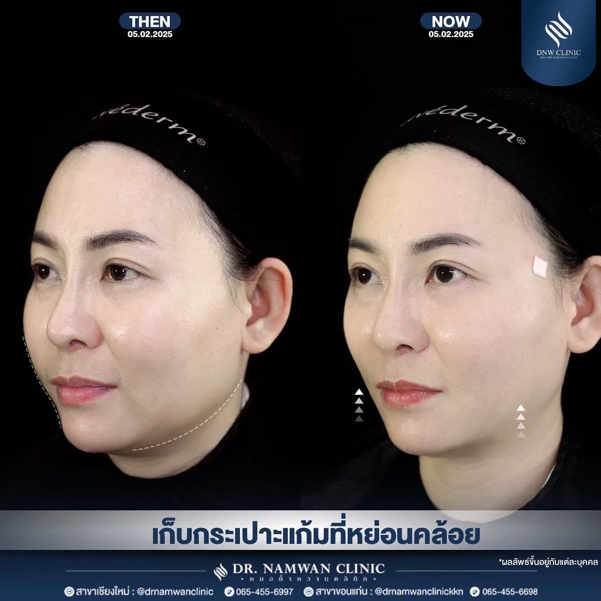ผลลัพธ์ก่อน–หลัง โปรแกรมร้อยไหม MINT