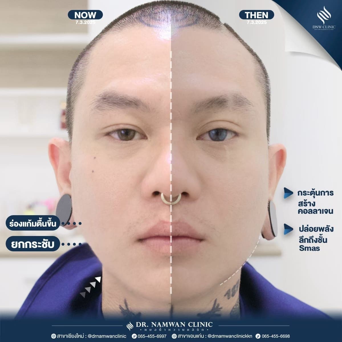 ผลลัพธ์ก่อน–หลัง โปรแกรมUltra Face Lift