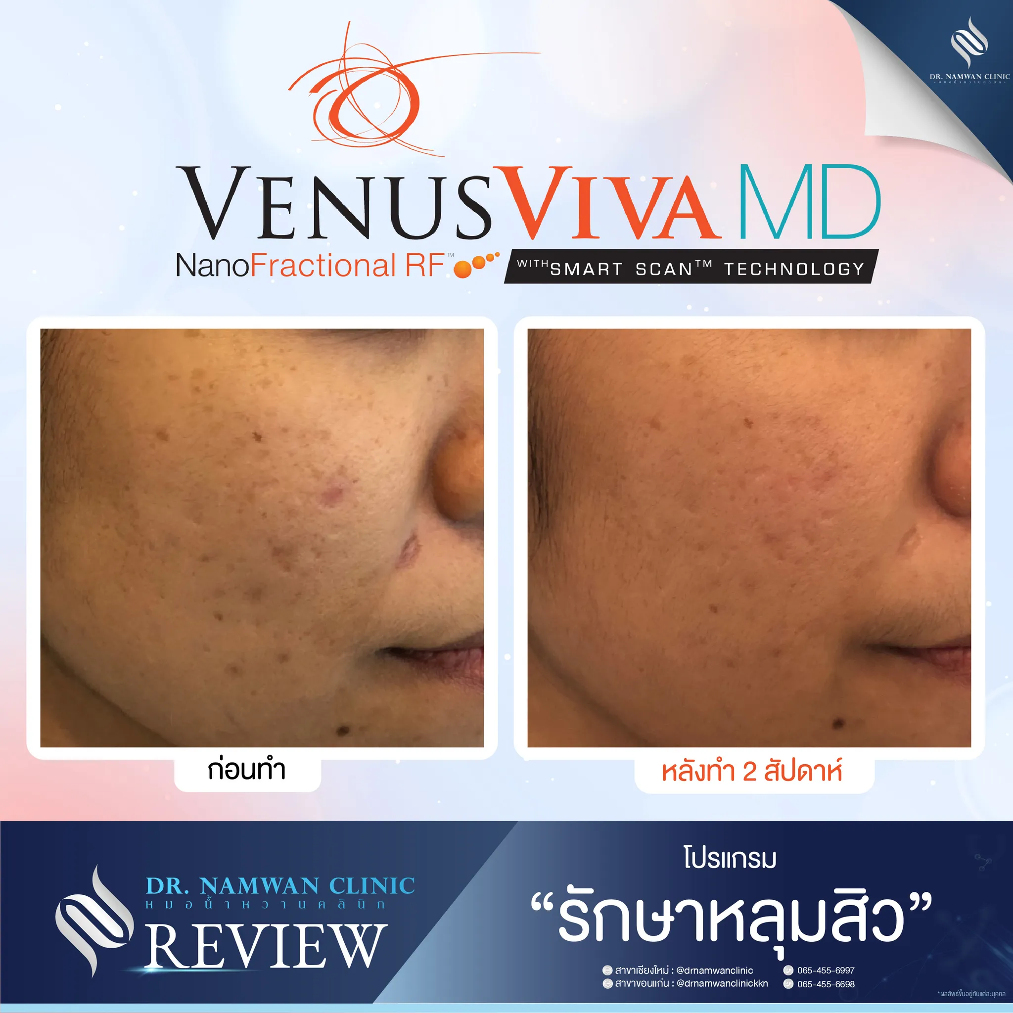 Before and after: Venus Viva MD